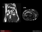 ostéonécrose post-traumatique du lunatum: IRM